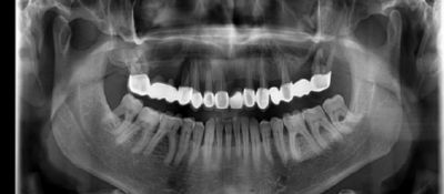 Radiografie a pacientului cu o punte dentară veche pe dinți compromiși, care dorește o dantură fixă pe 4 implanturi (All-on-4) în Moldova